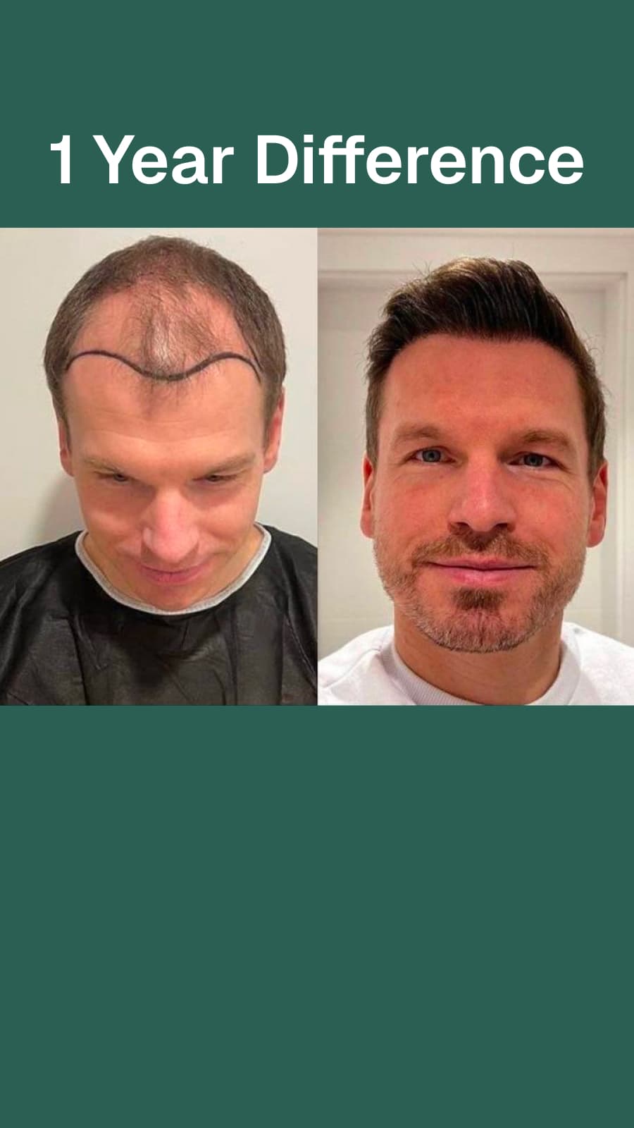 Пересадка волос