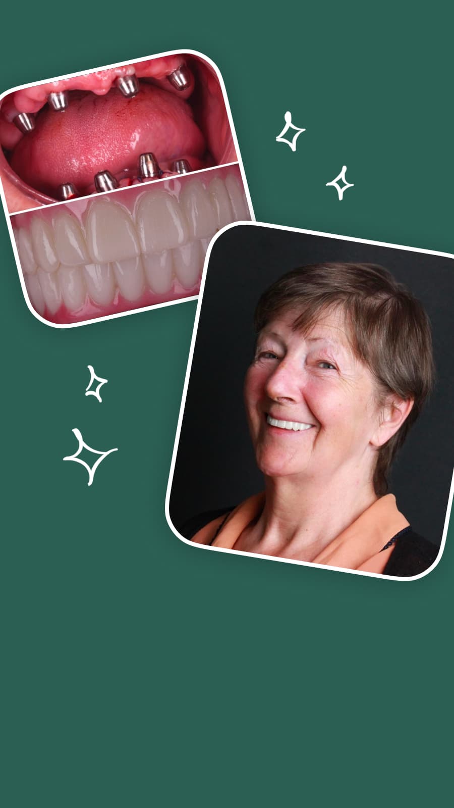 Импланты + Коронки